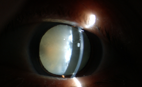 白內(nèi)障癥狀